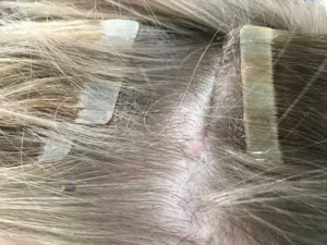 18 6 2 tape extensions might make your scalp itchy